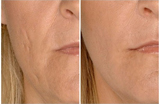 Dermal filler before and after