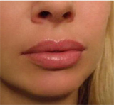 Dermal filler cream